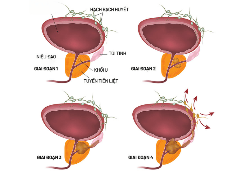 Hình ảnh minh họa 4 giai đoạn của ung thư tại tiền liệt tuyến