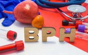 Phì đại tuyên tiền liệt (BPH) là căn bệnh phổ biến về tuyến tiền liệt ở nam giới