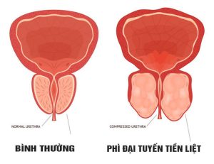 Phì đại tuyến tiền liệt là bệnh lý thường gặp ở nam giới ngoài 60 tuổi