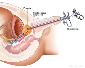 Phẫu thuật tuyến tiền liệt cần phẫu thuật khi bác sĩ chỉ định